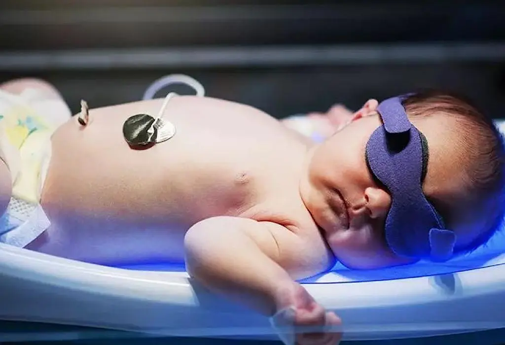 Mengenal Tanda-Tanda Kuning Normal vs Bahaya pada Bayi Baru Lahir (Jaundice)