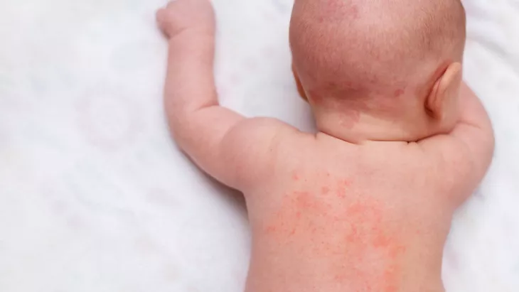Cara Mengatasi Biang Keringat (Miliaria) pada Leher dan Punggung Bayi